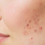 Simple Tips to Prevent pimples : మొటిమలు నివారించే సింపుల్‌ చిట్కాలు