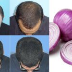 Onion Benefits for Hair : జుట్టు పెరుగుదలకు ఉల్లిపాయ మేలు