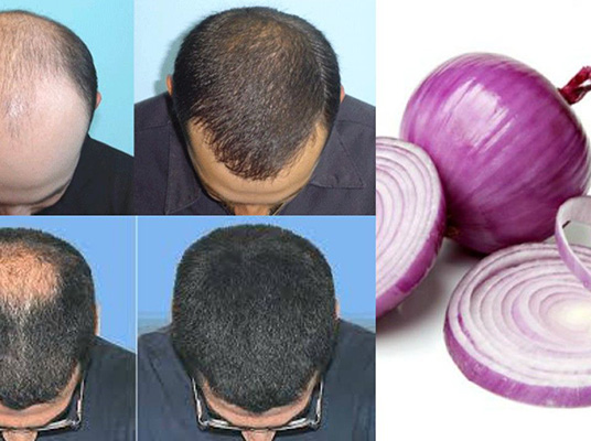 Onion Benefits for Hair : జుట్టు పెరుగుదలకు ఉల్లిపాయ మేలు
