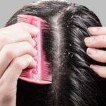 Tips for Dandruff : ఇలా చేస్తే చుండ్రు ఉండదు