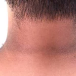 Dark Neck : మెడ నలుపును పోగొట్టే చిట్కాలు