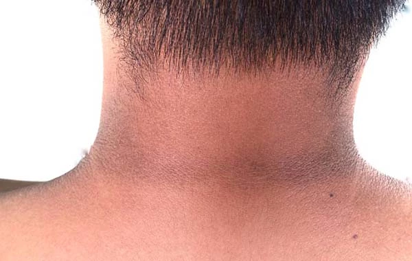 Dark Neck : మెడ నలుపును పోగొట్టే చిట్కాలు