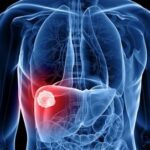 Liver Cells : ట్యూమర్‌ రాకుండా కాపాడే లివర్ సెల్స్..