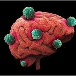 Brain Cancer:- ప్రాణాంతక బ్రెయిన్ క్యాన్సర్‌ను కనుక్కునే టెక్నాలజీ..