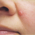 skin cancer : అతిచిన్న మైక్రో స్కిన్ క్యాన్సర్.. గిన్నీస్ రికార్డ్‌లో పేరు..