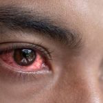 Conjunctivitis cases : కళ్ల కలకతో కలవరం.. వేలల్లో కేసులతో కలకలం..