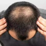 Hair Loss: ఈ డ్రింక్స్ తాగుతున్నారా.. అయితే బట్టతల రావడం ఖాయం!