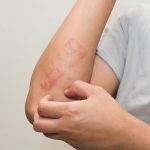 Food Allergy : ఫుడ్ అలర్జీతో బాధపడుతున్నారా? ..ఈ చికిత్సలతో చెక్ పెట్టండి..!