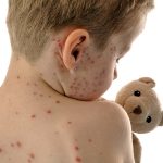 Measles: మళ్లీ పెరిగిన మీజిల్స్‌.. మధ్యప్రదేశ్‌లో ఇద్దరు చిన్నారులు మృతి..