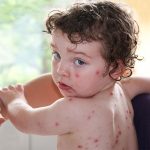 Chickenpox : అమ్మవారు వస్తే ఏం చేయాలి..?