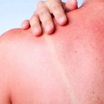 Sun Burn: సన్‌బర్న్ నివారణకు అద్భుతమైన చిట్కాలు..