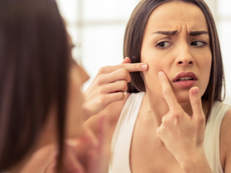 Acne Free Skin: ఈ టిప్స్ పాటిస్తే మీ ఫేస్‌పై ఒక్క మొటిమ కూడా ఉండదు తెలుసా ?