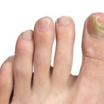 Nails Health : బొటనవేలి గోరులో పగుళ్లు.. ఆ ఇన్ఫెక్షన్ కావచ్చు..!